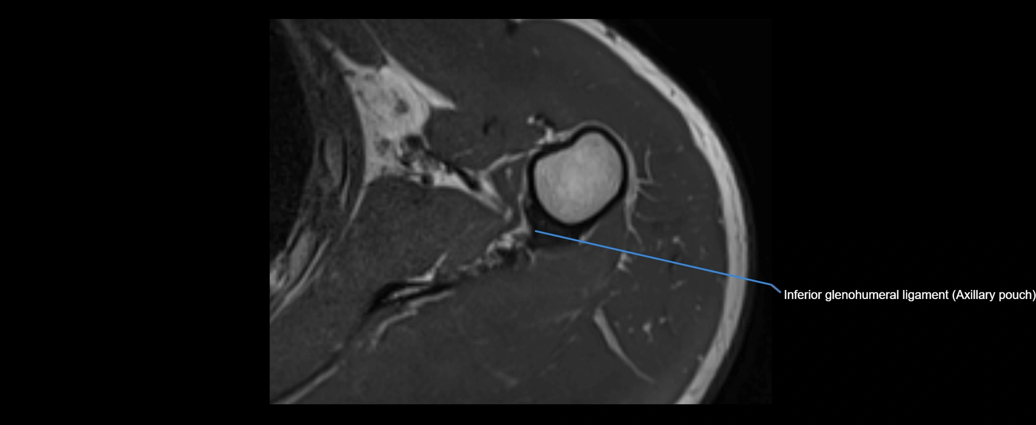 shoulder ligaments axial 3d 3t mri image-img-00005-00092.webp